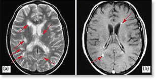 Abbildung: Entzündliche Plaques im Gehirn